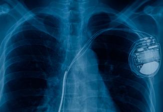 Pacemaker